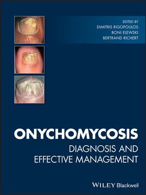 cover image of Onychomycosis